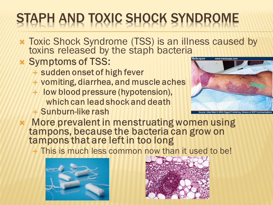 Understanding Toxic Shock Syndrome -- the Basics